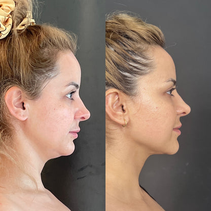 Chinplify™ — Get Rid of Your Double Chin